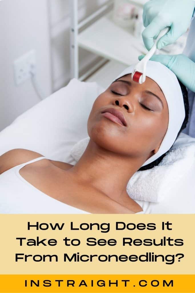 lady in a microneedling session